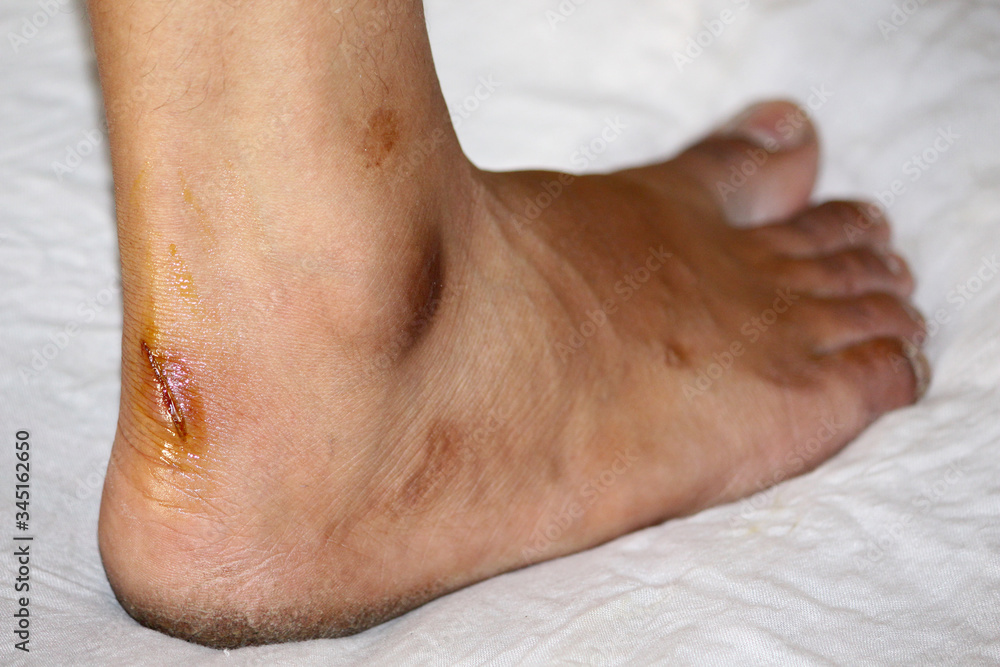 injury wound in male foot an accident injury wound in male foot an accident