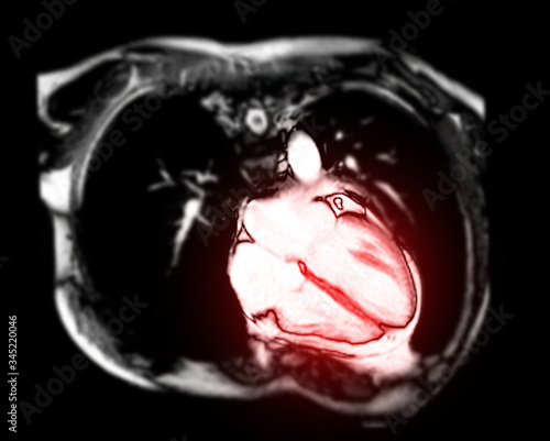 Tableau sur toile MRI heart or Cardiac MRI ( magnetic resonance imaging ) of heart  vertical axis view showing 4 chamber of the heart  for diagnosis heart disease