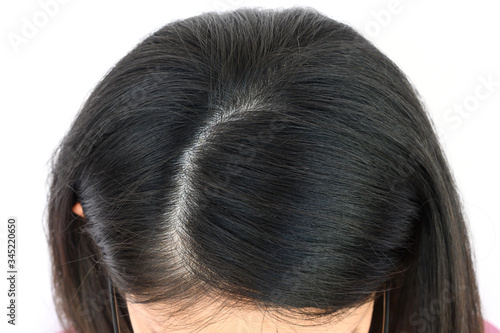 Fotografie Cropped view of woman top's head with part of her thin hair, she had hair loss problem