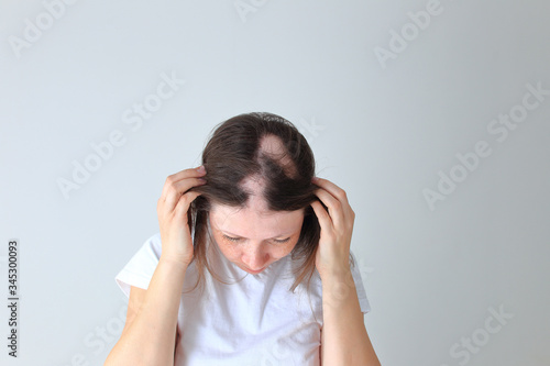 Real alopecia areata in a young girl. A bald head in a person.