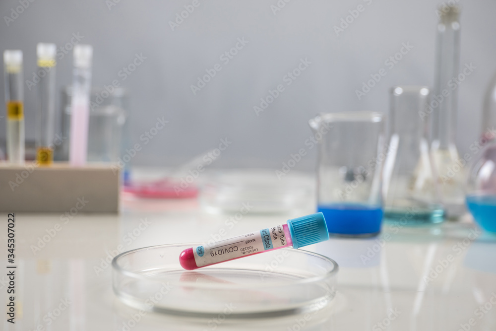 Positive blood test result for the new rapidly spreading Coronavirus, originating in Wuhan, China Positive blood test result for the new rapidly spreading Coronavirus, originating in Wuhan, China
