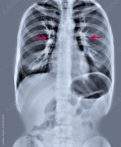 x-ray of the lungs with damage to the roots of the lungs in pneumonia coronavirus