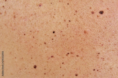 Many birthmark and moles on skin. photo 