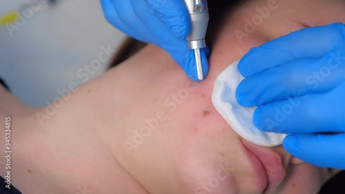 Wallpaper Mural Process of removing mole using laser on woman's face by surgeon, burning skin, closeup view. Cosmetic treatment in beauty clinic. One day surgery concept. Removing birthmark surgical procedure. Torontodigital.ca