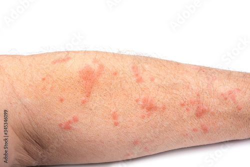 Skin disease rash on a man arm photo