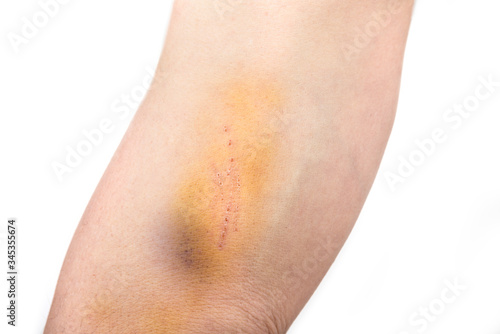Yellow and blue bruise on a man arm