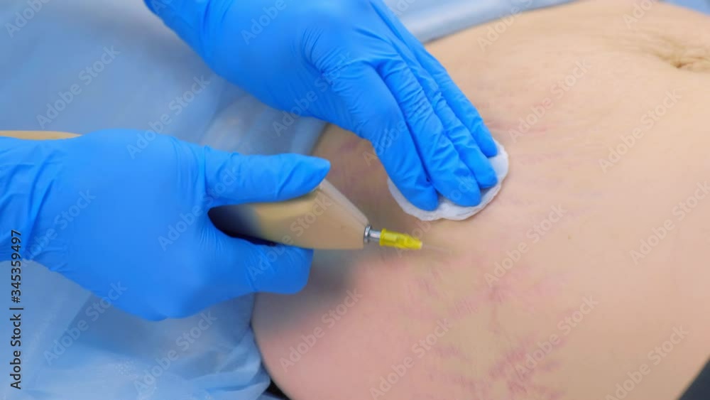 Doctor making injection of carbon dioxide on patient abdomen on carboxytherapy, tummy closeup. Cosmetologist woman using special apparatus. Treatment, cure and remove of skin tags and stretches. Doctor making injection of carbon dioxide on patient abdomen on carboxytherapy, tummy closeup. Cosmetologist woman using special apparatus. Treatment, cure and remove of skin tags and stretches.