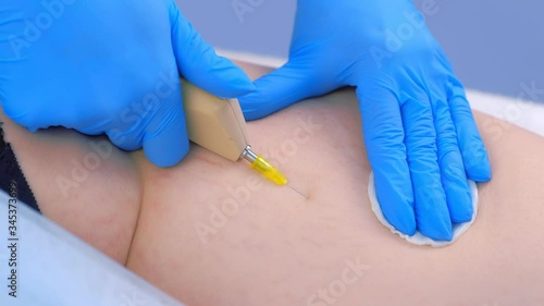 Doctor making injection of carbon dioxide on patient booty on carboxytherapy, closeup view. Cosmetologist woman using special apparatus. Treatment, cure and remove of skin tags and stretches.