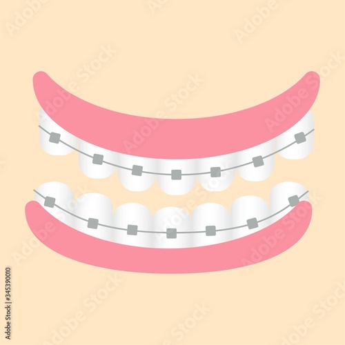Gum, teeths with metallic braces isolated stock vector illustration. Graphic bright clipart, dental, orthodontic concept. Healthcare and medicine beauty.