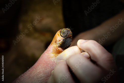 Tableau sur toile Gangrene of the toe of an old grandmother