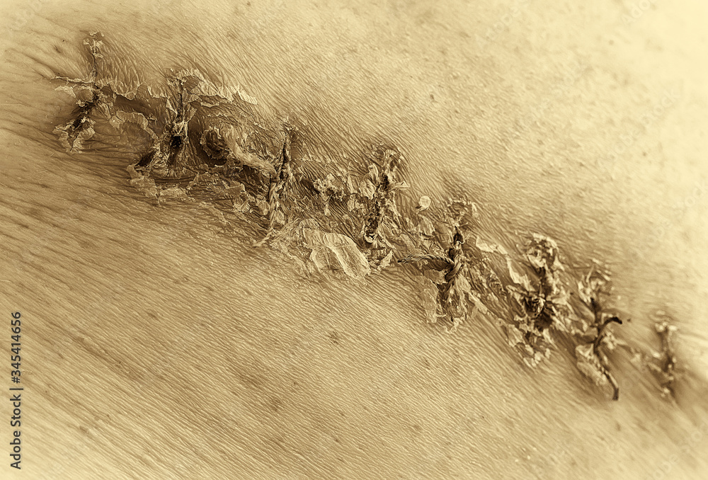 Macro close up, black and white, sepia. Medical scar after surgery after removal of a cancerous tumor - a bad big mole, a color picture, stitches of a seam, a thread with knots.