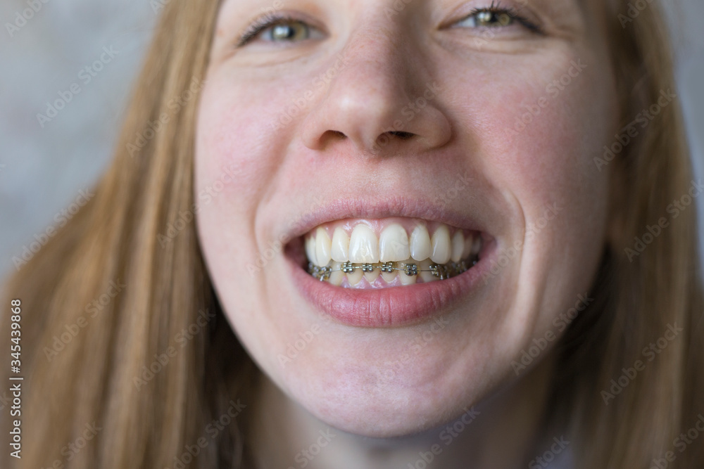 Fototapeta premium Close-up portrait of smiling girl with metal braces on the lower jaw. Tooth alignment. Crooked teeth