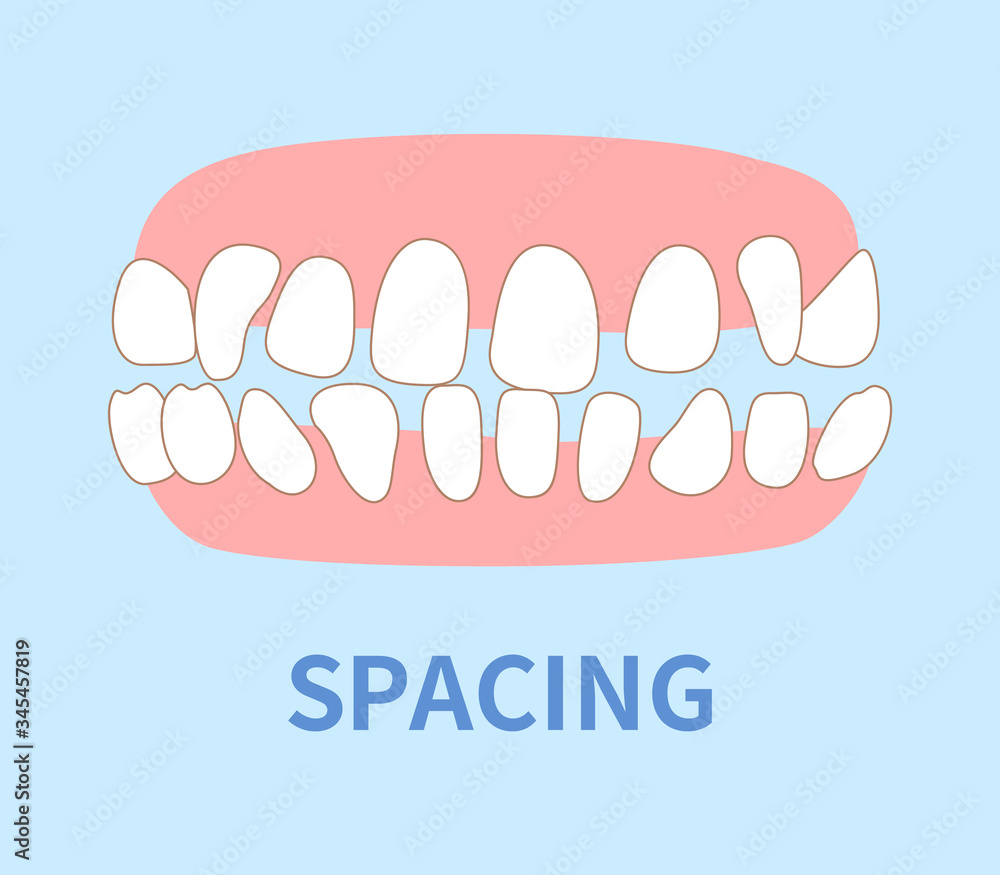 orthodontics illustrations ; spacing tooth orthodontics illustrations ; spacing tooth
