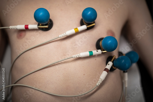 A patient with EKG electrodes attached to his body.