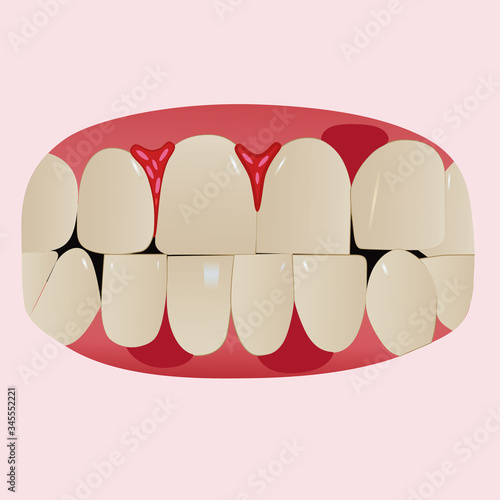 A teeth vector related to gingivitis disease. Hand-drawn bleeding gums illustration. Dental health concept design, printable eps 10 file format.