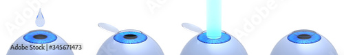 Laser eye surgery procedure. 3D-rendering.