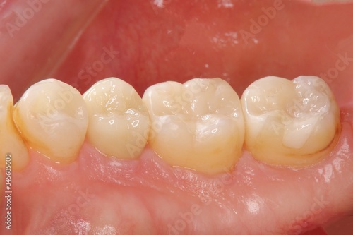歯科 虫歯治療