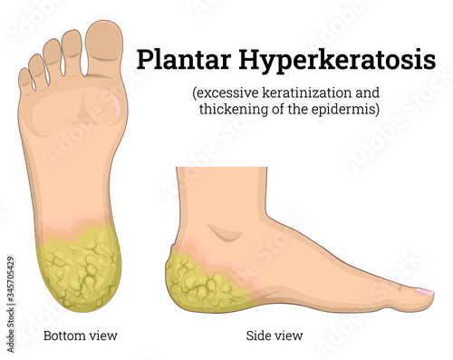 Illustration of dermatological diseases Plantar Hyperkeratosis