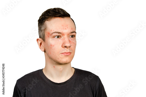 Portrait of young man with allergy, with red face, isolated, © vika33