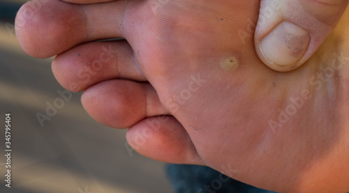 Close up shot of a warty Caucasian man's foot. The fingers of the hand inspect the skin near the infected area.