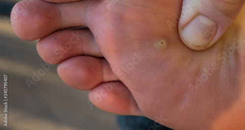 Close up shot of a warty Caucasian man's foot. The fingers of the hand inspect the skin near the infected area.