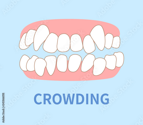 orthodontics  illustrations ; crowding tooth