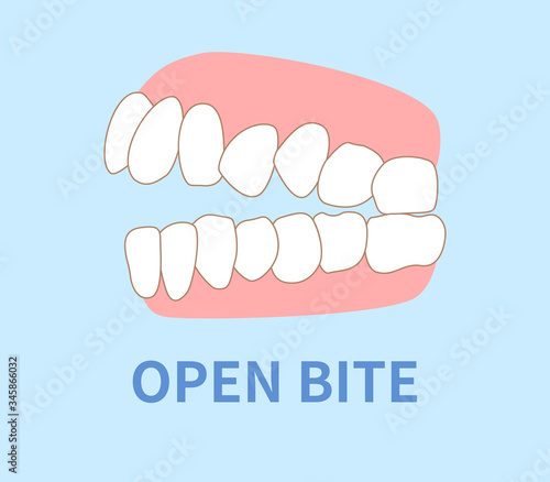 orthodontics  illustrations ; open bite tooth