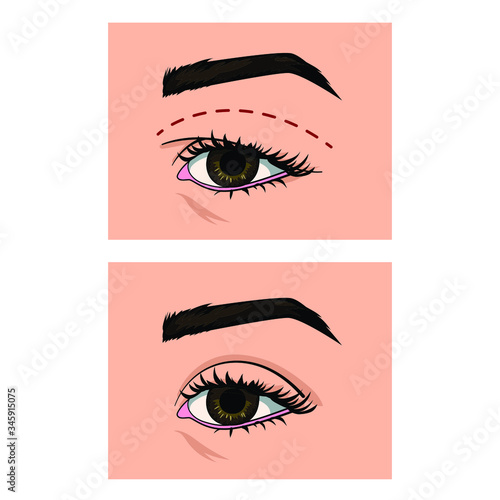 Eyes comparison. Eyelids before and after surgery. Blepharoplasty. overhanging Upper eyelid correction. Excess skin and fat removal plastic surgery. Isolated vector illustrations.  photo