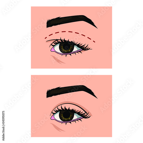 Eyes comparison. Eyelids before and after surgery. Blepharoplasty. overhanging Upper eyelid correction. Excess skin and fat removal plastic surgery. Isolated vector illustrations. 