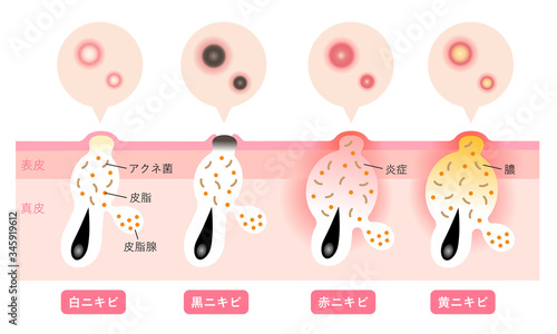 ニキビの症状