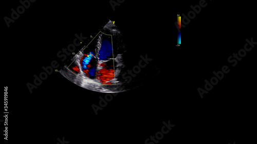 Image of the heart during transesophageal ultrasound with Doppler mode.