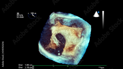 3D image of the heart during transesophageal ultrasound of the heart.