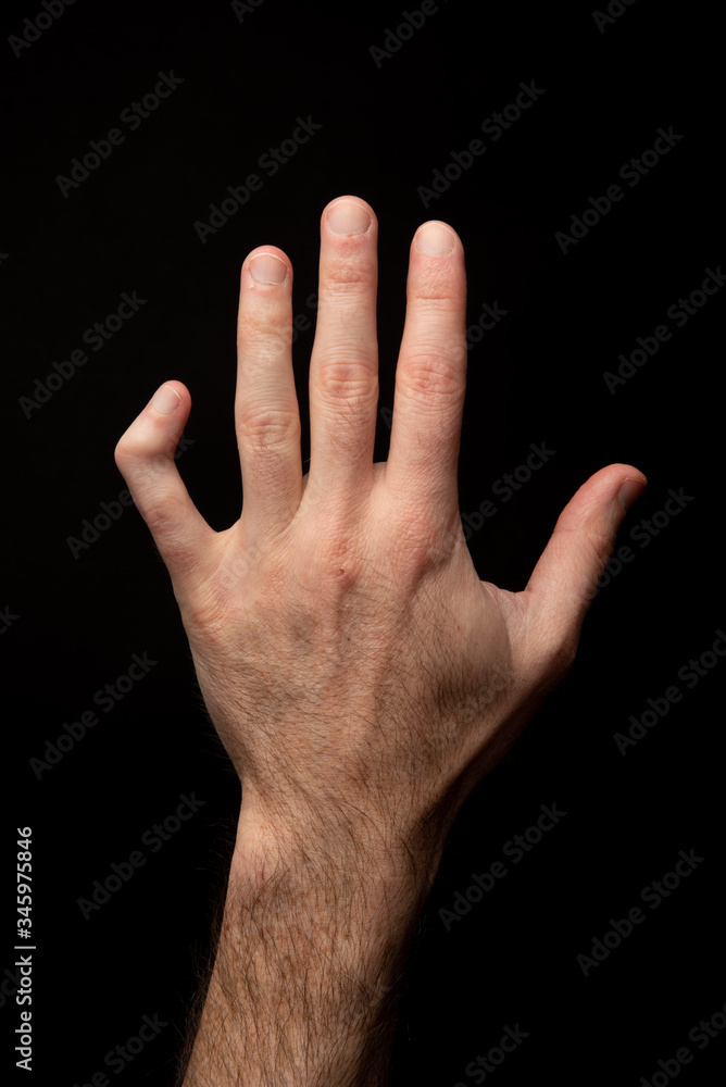 Orthopedic medicine. Back view of a broken and deformed little finger of a male hand, external ligament injury. Black background
