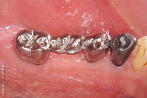 銀歯　ブリッジ