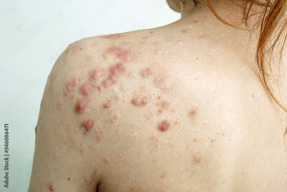 Keloids and scars on the back after treating acne problems in young