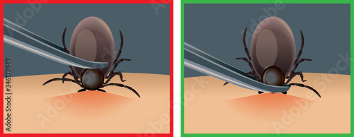 how to get a tick correctly. Mite parasites. Tick parasite removing by tweezers vector illustration. Mite parasites. Acarus. Mite spider. Mite epidemic.
