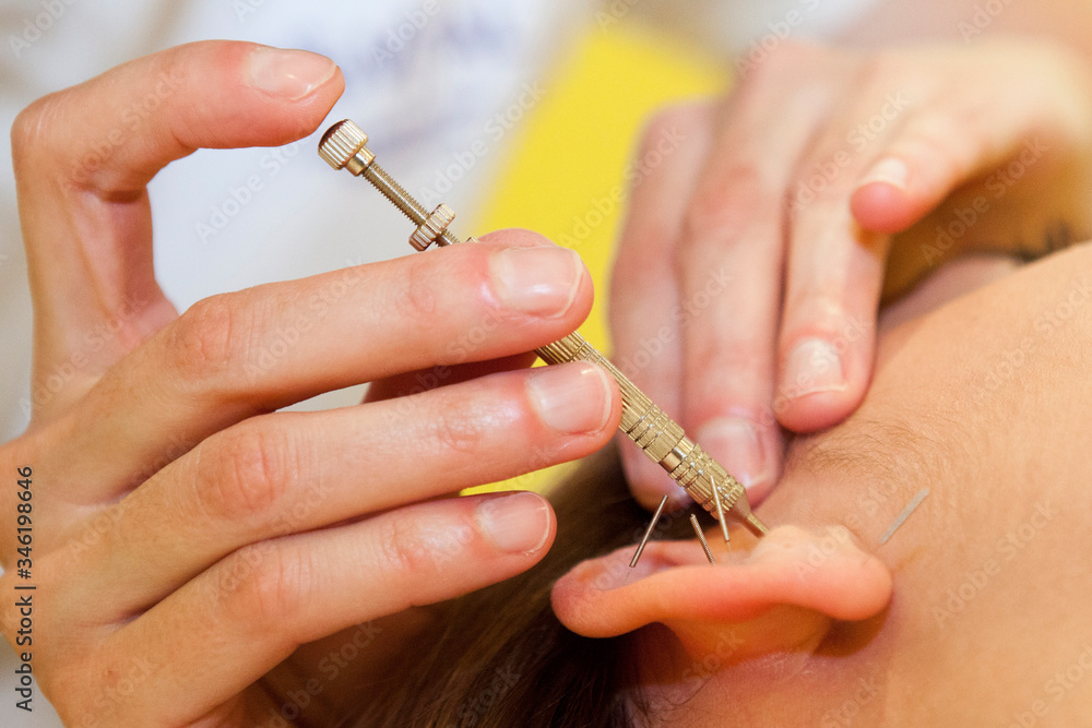Obraz premium acupuntura, fisioterapeuta, oreja, aguja