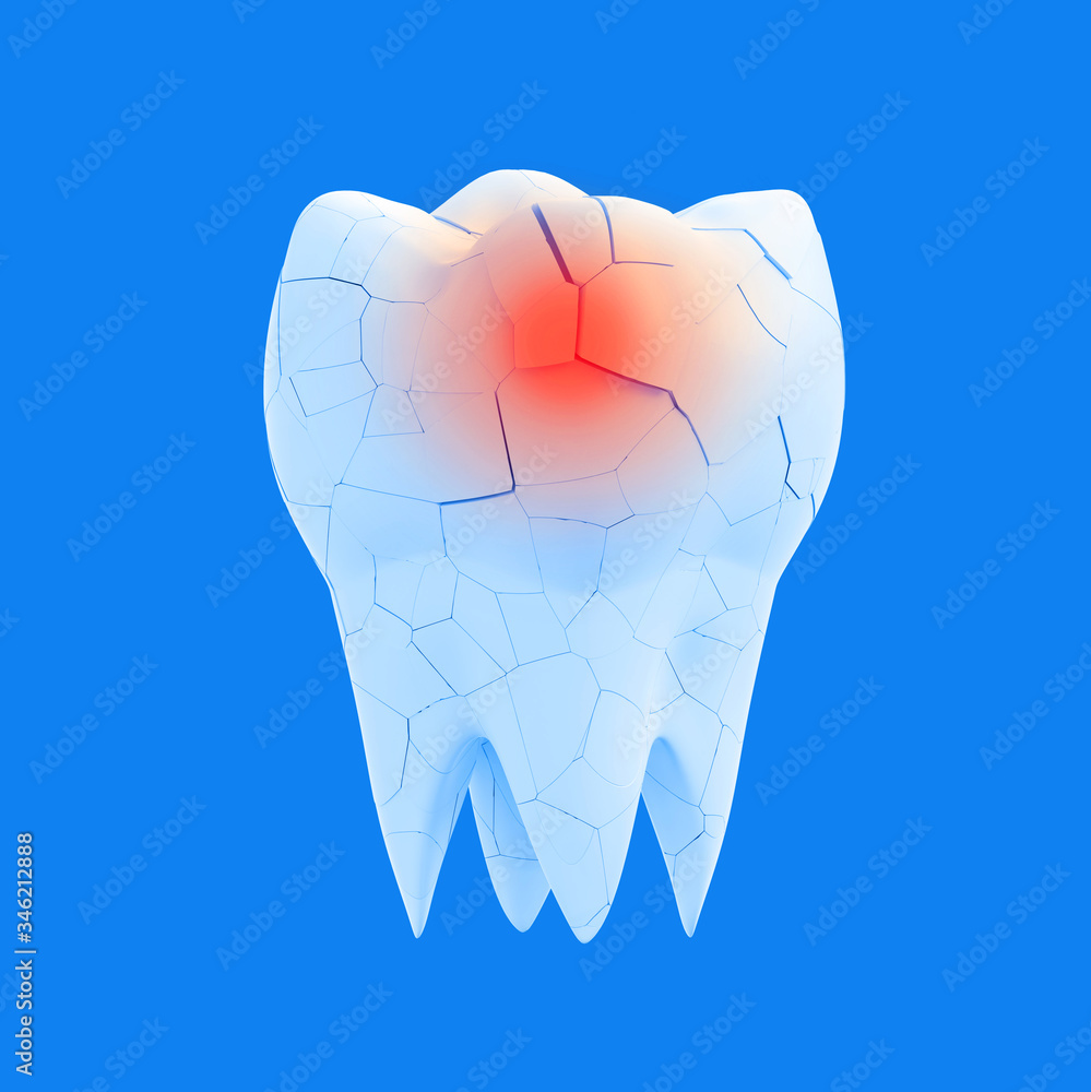 Broken molar tooth with red dot on blue background. Cracked Enamel