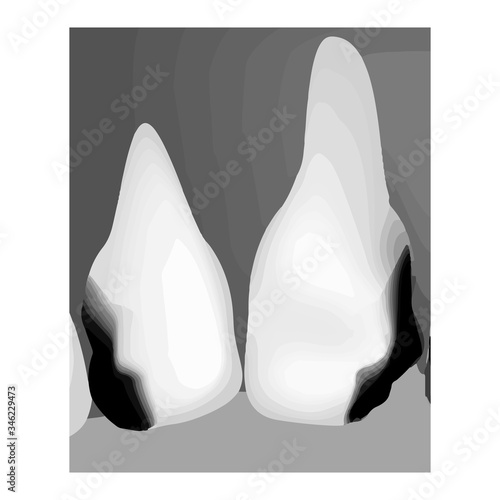 Dental caries. X-ray of tooth decay. Caries infographics. Vector illustration on isolated background.