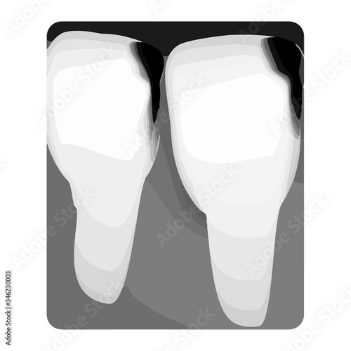 Dental caries. X-ray of tooth decay. Caries infographics. Vector illustration on isolated background.