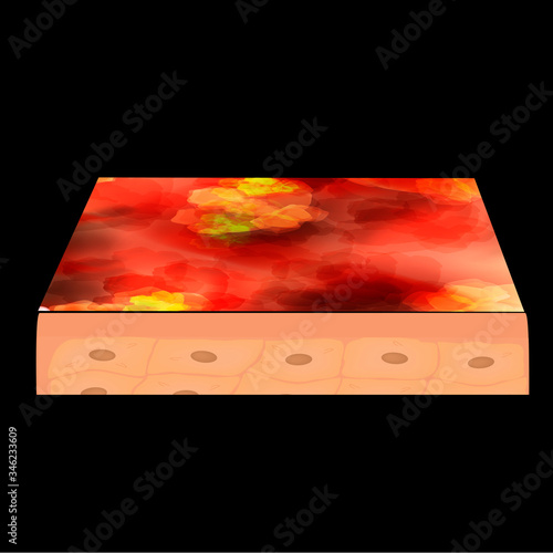 Cyst acne. furuncle Acne on the skin cysts and pimples. Dermatological and cosmetic inflammatory diseases on the skin of the face. Infographics. Vector illustration on isolated background.