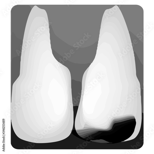 Dental caries. X-ray of tooth decay. Caries infographics. Vector illustration on isolated background.