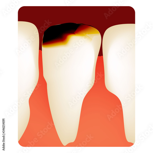 Dental caries. tooth decay. Caries infographics. Vector illustration on isolated background.