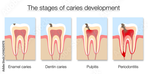 Caries stages chart, development of tooth decay with enamel and dentin caries, pulpitis and periodontitis. Isolated vector illustration on white background.
