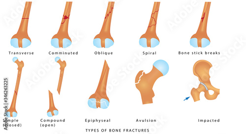 Types of Bone Fractures. Different kinds of fractures. Descriptive illustration with examples of fractures of the femur bone on white background