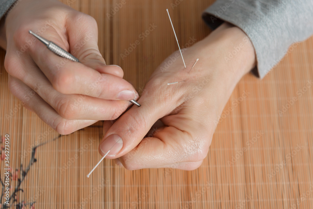 Man using acupuncture treatment for pain relief