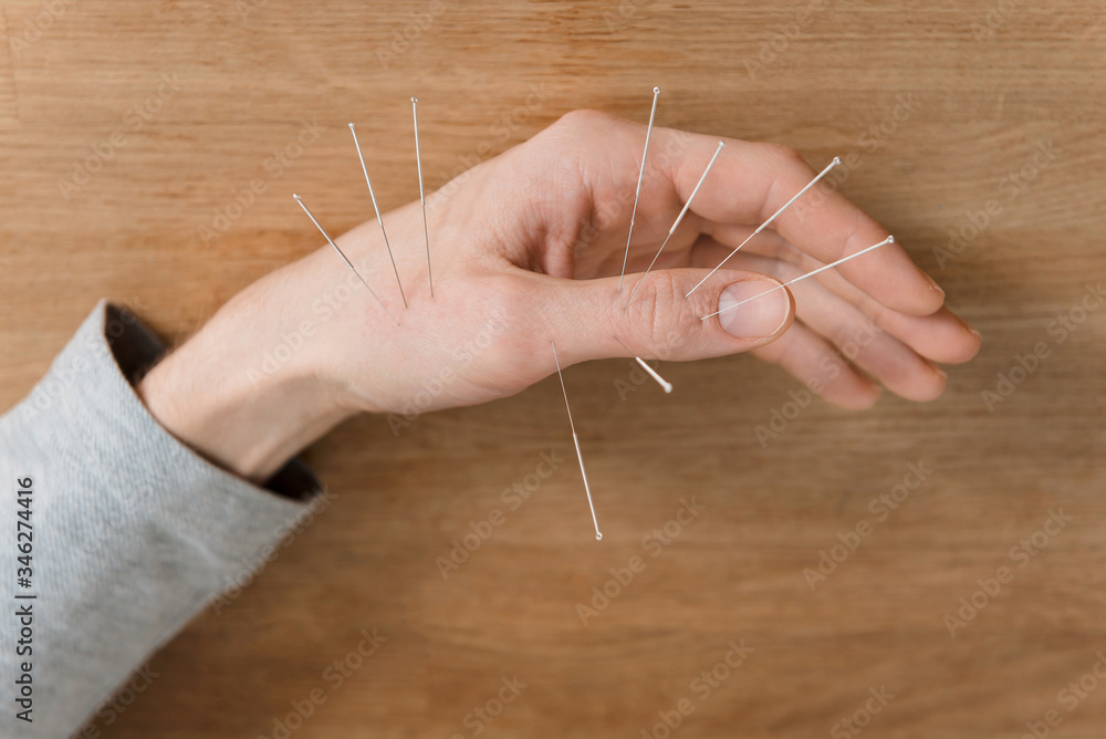 Man using acupuncture treatment for pain relief Man using acupuncture treatment for pain relief