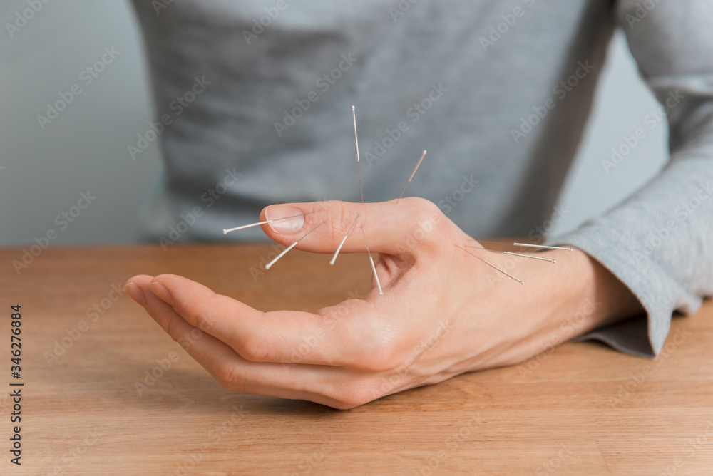 Man using acupuncture treatment for pain relief Man using acupuncture treatment for pain relief