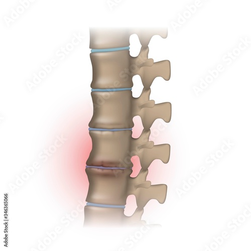Human spine with degeneration of the vertebral discs, osteochondrosis and joint inflammation
