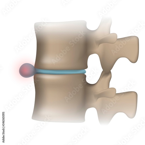 Close-up of a human spine with intervertebral hernia on a white background